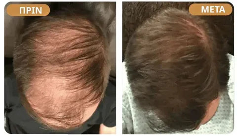 Hairzen Hair Root Activator Shampoo ™