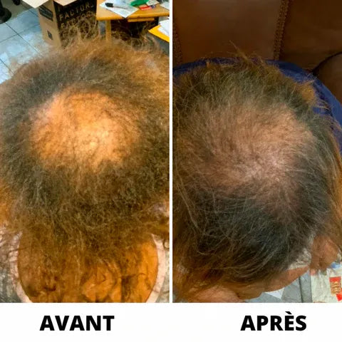 Sérum de Croissance Capillaire Hairzen ™